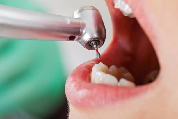 Best Emergency Dental Extractions in Byers, CO